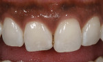 Figure  1  CLINICAL EXAMPLES Excessive incisal wear was evident on the right central incisor.