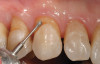 Figure 16  Teeth Nos. 8, 9, and 10 were removed and immediate implants placed at the Nos. 8 and 10 sites.