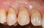 Figure  5  CLINICAL EXAMPLES The tooth was isolated with a small-diameter retraction cord and a resin-modified glass ionomer was placed as an initial layer.
