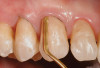 Figure 18  Final restoration was achieved with a three-unit zirconia prosthesis: No. 8—implant abutment, No. 9—pontic, and No. 10—abutment.