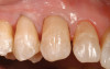 Figure 19  A patient presented requiring extraction of teeth Nos. 8 and 9; note the excellent papilla levels.