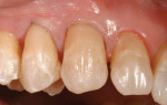 Figure  7  CLINICAL EXAMPLES An enamel shade was sculpted and blended to the tooth for a natural, layered appearance.