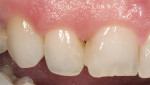 Figure  9  CLINICAL EXAMPLES Failing existing composite resin restorations on the right central and lateral incisor due to recurrent decay. (