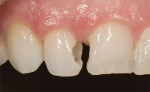 Figure  10  CLINICAL EXAMPLES Tooth preparation was done after removal of the existing composite resin and recurrent decay.