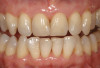 Figure 24  Minimal gingival scallop because of the apically placed papilla and a long contact is the expected outcome in a patient with significant interproximal bone loss before implant placement.