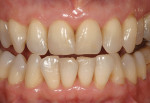 Figure  12  CLINICAL EXAMPLES Esthetic restorative correction was wanted on both central incisors.