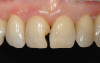 Figure 27  The lateral incisor implant was put to sleep and the cuspid implant uncovered.