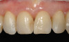 Figure 28  The final restoration exhibits a cantilevered incisor off of a canine implant.