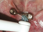 Fig 5. Use of the Power Tip brush head to clean the standard overdenture Hader bar. Note extension of bristles beneath the bar.