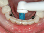 Fig 8. The inferior surface of this fixed complete implant denture is successfully accessed for hygiene from a lingual perspective using the Power Tip brush head.
