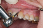 Figure  9  Shaping the restoration, making sure to not over-reduce the composite, which would create a deficiency with the free gingival margin.