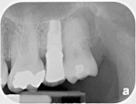Fig 17. Periapical radiograph at 2 years suggested stable bone levels.