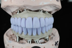Fig 3. Lithium-disilicate crowns in blue phase. Crowns were designed in CAD software and milled on the Versamill 5XS.