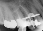 Figure  1  CLINICAL EXAMPLES Tooth No. 4, filled canals.