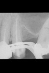 Figure  2  CLINICAL EXAMPLES Tooth No. 13, filled canals.