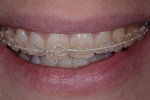 Month 2 of orthodontic treatment.