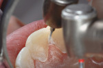 Figure  11  A Brasseler 8392-016 bur was used to refine the lingual and labial embrasure spaces.