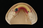 Fig 21. A bilaterally screw-retained wax rim is measured, cut, and fixed to the baseplate.
