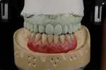 Fig 26. The completed wax try-in with gingival contouring and color.
