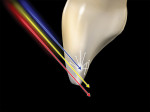 Figure  17  Blue light tends to scatter within the enamel body and the red–yellow wavelengths transilluminate in a much higher relative percentage.