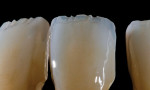 Figure  22  An angled surface has been created on the pressed copings with a high enough angle to scatter the red–yellow wavelengths. This will create a natural-looking incisal halo.