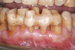 Figure  1  CASE PRESENTATION Preoperative clinical view. Teeth Nos. 22 through 27 showed splinting and heavy staining.