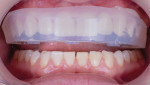 Patient is fitted with the trial smile using a clear matrix.