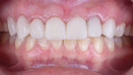 Trial smile bonded during marginal healing period.