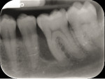 Fig 2. Pre-orthodontic radiograph showed the extent of the infrabony defect on tooth No. 19.
