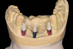 Figure  14  CASE PRESENTATION The laboratory-modified prefabricated zirconia abutments would allow enhanced esthetics in the final restoration.