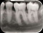 Fig 8. Radiograph made 4 years post-orthodontic movement. Note the complete radiographic fill of the mesial infrabony defect with continued remodeling and re-establishment of the lamina dura.