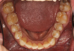 Fig 9. Four-year post-orthodontic follow-up, occlusal view (Fig 9) and left side buccal view (Fig 10), which indicated stable, healthy gingival levels at No. 19 with no obvious signs of inflammation.