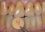 Figure  15  CASE PRESENTATION Custom porcelain shade tabs were used to match the highly characterized dentition of the patient.