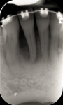 Fig 19. Radiograph after 8 months of orthodontic tooth movement. Tooth No. 25 was being moved directly into and through the grafted extraction site of No. 26. Note the
increased radiopacity of the bone biomaterial, indicating formation of mineralized native bone.