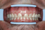Figure  2  View of the patient’s smile showing uneven gingival architecture, unesthetic PFM margins, excessive wear, and loss of vertical dimension due to attrition.