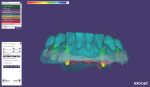 Fig 9. The software generates preformed telescopic abutments that can be edited.