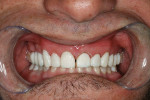 Figure  4  With the provisionals in place, a laser gingivectomy was performed, although tooth No. 9 could not tolerate further recontouring because of biological width issues.