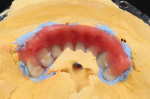 Fig 30. Darker shades of acrylic are placed near the vestibular area and blended back toward the attached gingiva.