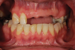 Fig 1. Pre-treatment frontal view shows setting for restoration of the missing front teeth.