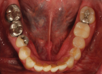 Fig 3. Evidence of patient’s prior head trauma and extensive dental treatments are shown in the pre-treatment maxillary occlusal view, pre-treatment mandibular occlusal view, and pre-treatment panoramic radiograph, respectively.