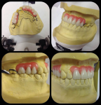 Fig 6. The diagnostic wax-up aided the prosthodontist to develop the RPD design.