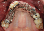 Fig 16. The RPD framework with angle-correcting attachments was tried in the patient’s mouth to ensure a passive fit.