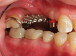 Fig 17. The RPD framework with angle-correcting attachments was tried in the patient’s mouth to ensure a passive fit.