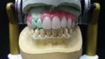 Fig 18. The occlusal and anterior denture teeth set-ups are shown here.
