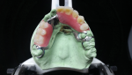 Fig 19. The occlusal and anterior denture teeth set-ups are shown here.