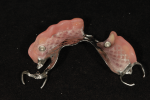 Fig 20. The prosthodontist provided the implant-assisted RPD by incorporating two clear nylon inserts chairside using a cold-cure acrylic.