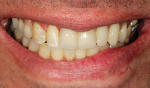 Fig 22. Post-treatment frontal view shows the final result.