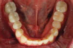 Figure 24. Post-treatment mandibular occlusal view shows the final result.