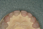 Figure  9  The outline of the incisal edge showed the 0.5-mm facial taper.