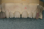 Figure  14  MM Light was used on the mesial and distal lobes; OE4 and Salmon were used on the middle lobes.